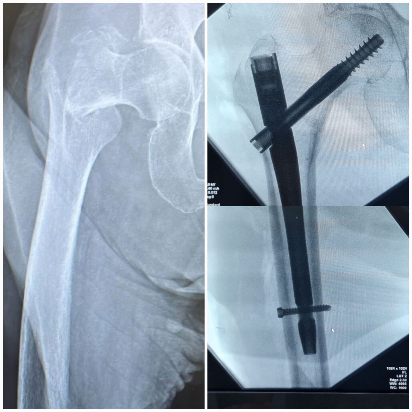 fratura-do-femur-proximal