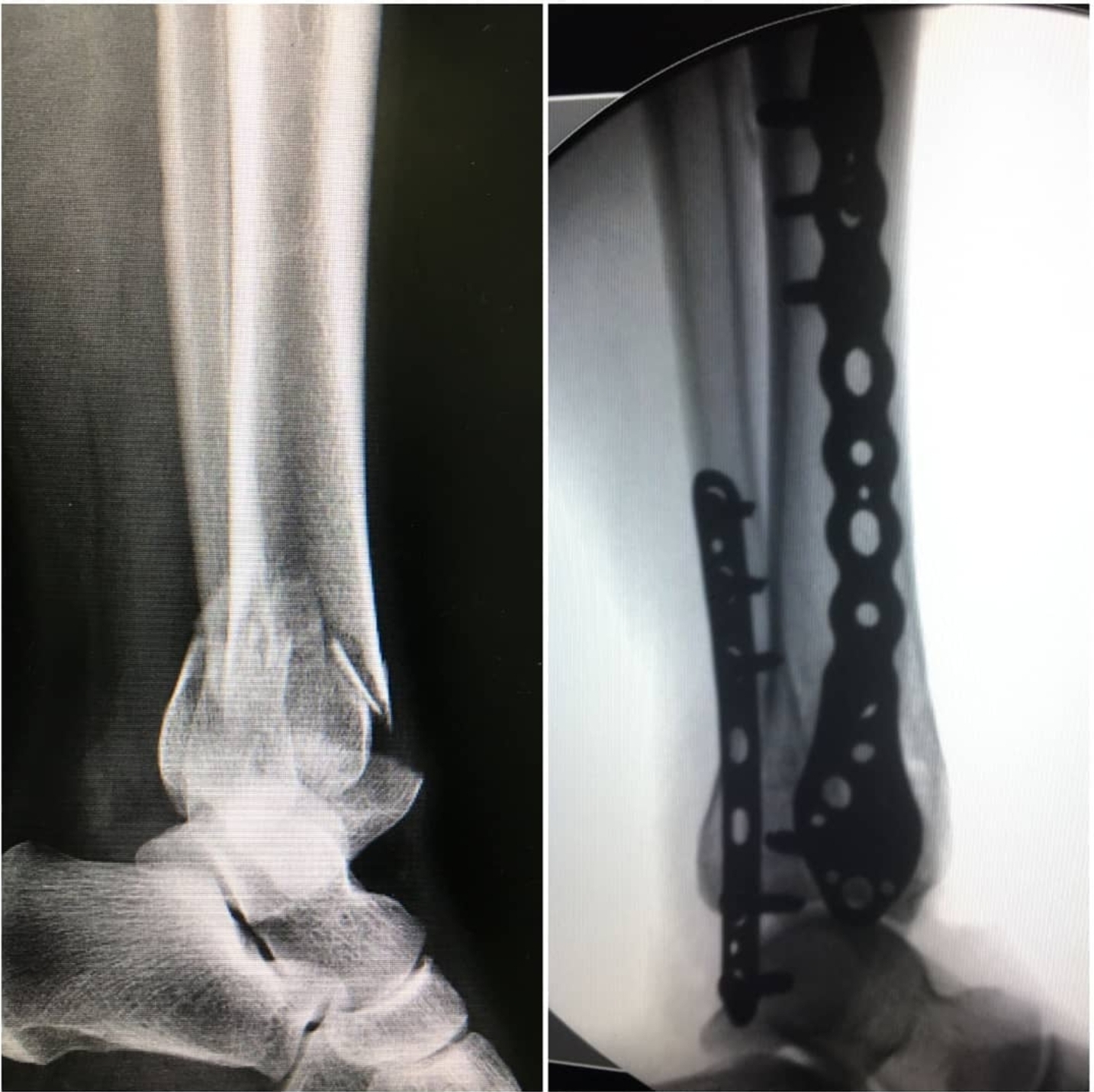 fratura-do-pilao-tibial-tratamento-cirurgico-2