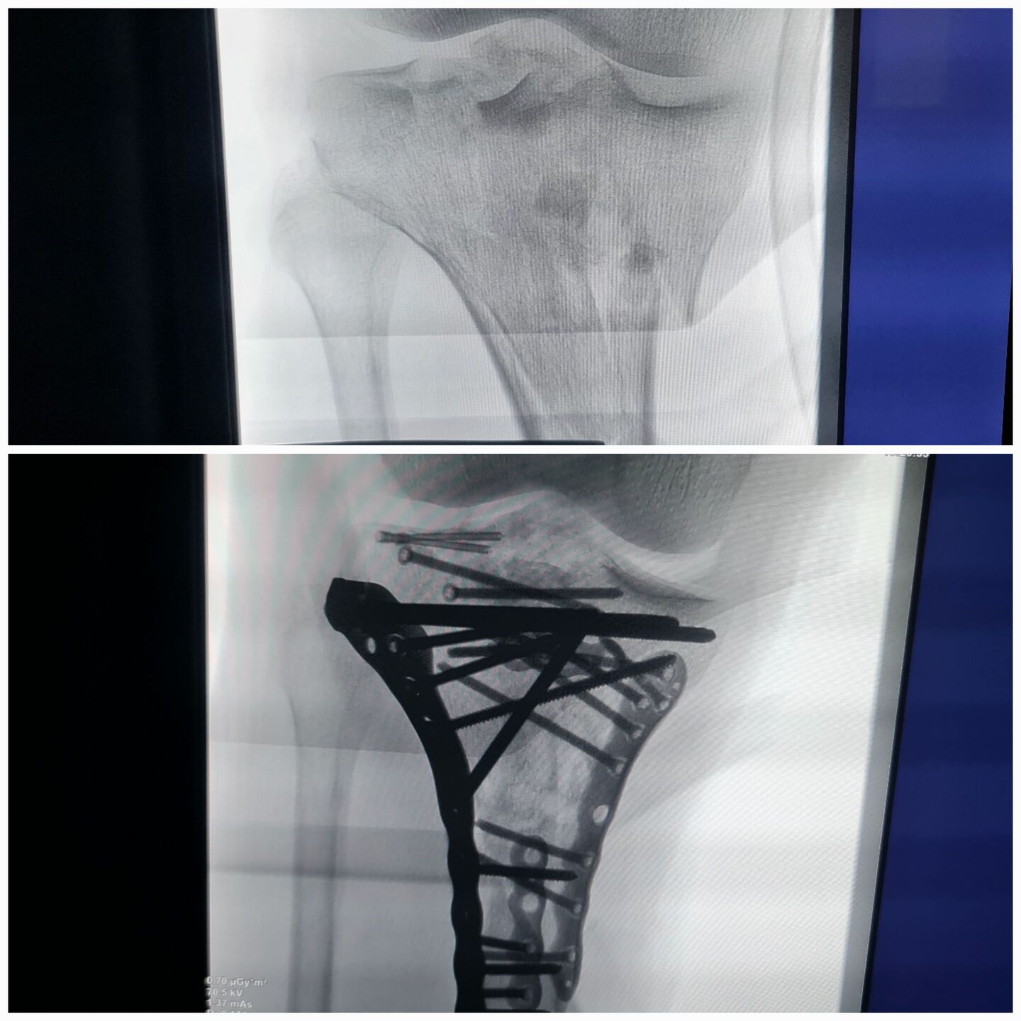 fratura-do-planalto-tibial-2