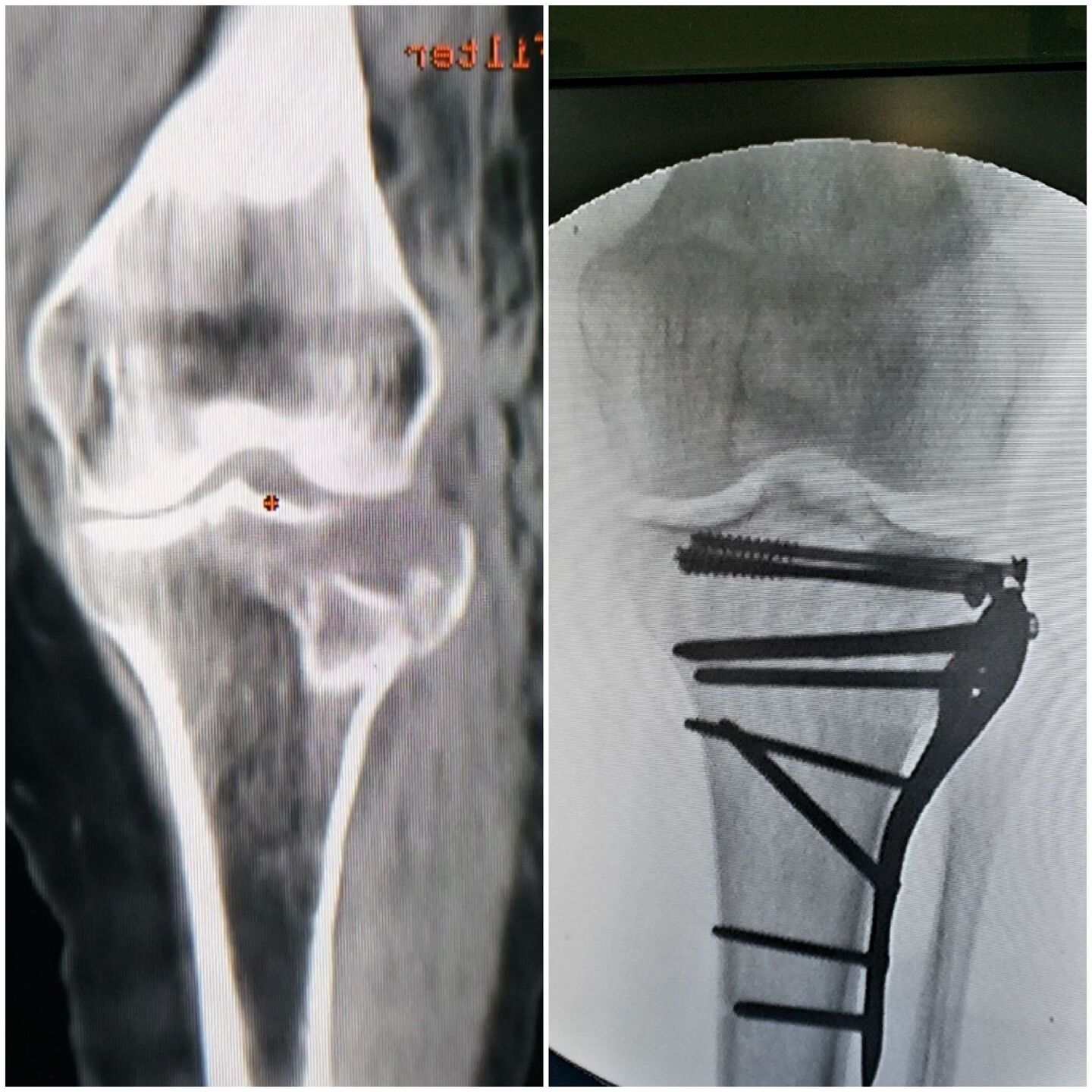 fratura-do-planalto-tibial-4