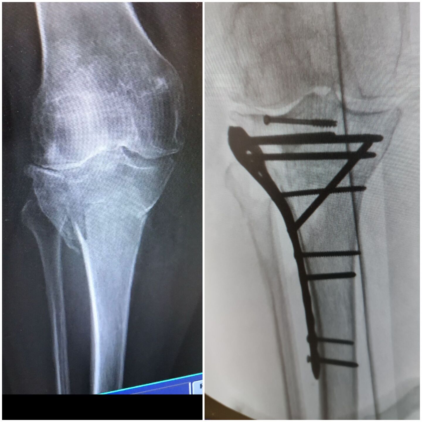 fratura-do-planalto-tibial-5