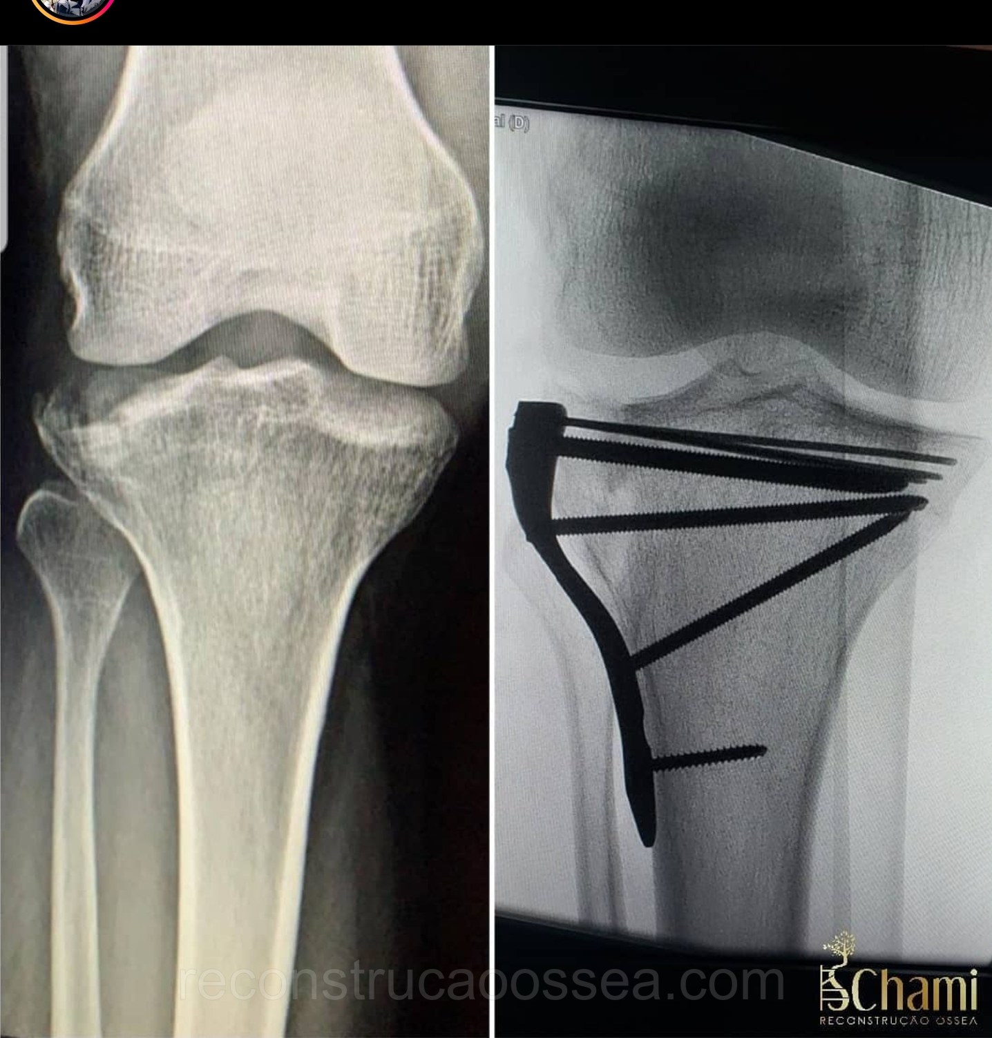 fratura-do-planalto-tibial-tratamento-cirurgico-1