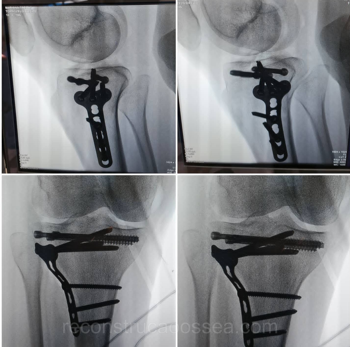 fratura-do-planalto-tibial-tratamento-cirurgico-11