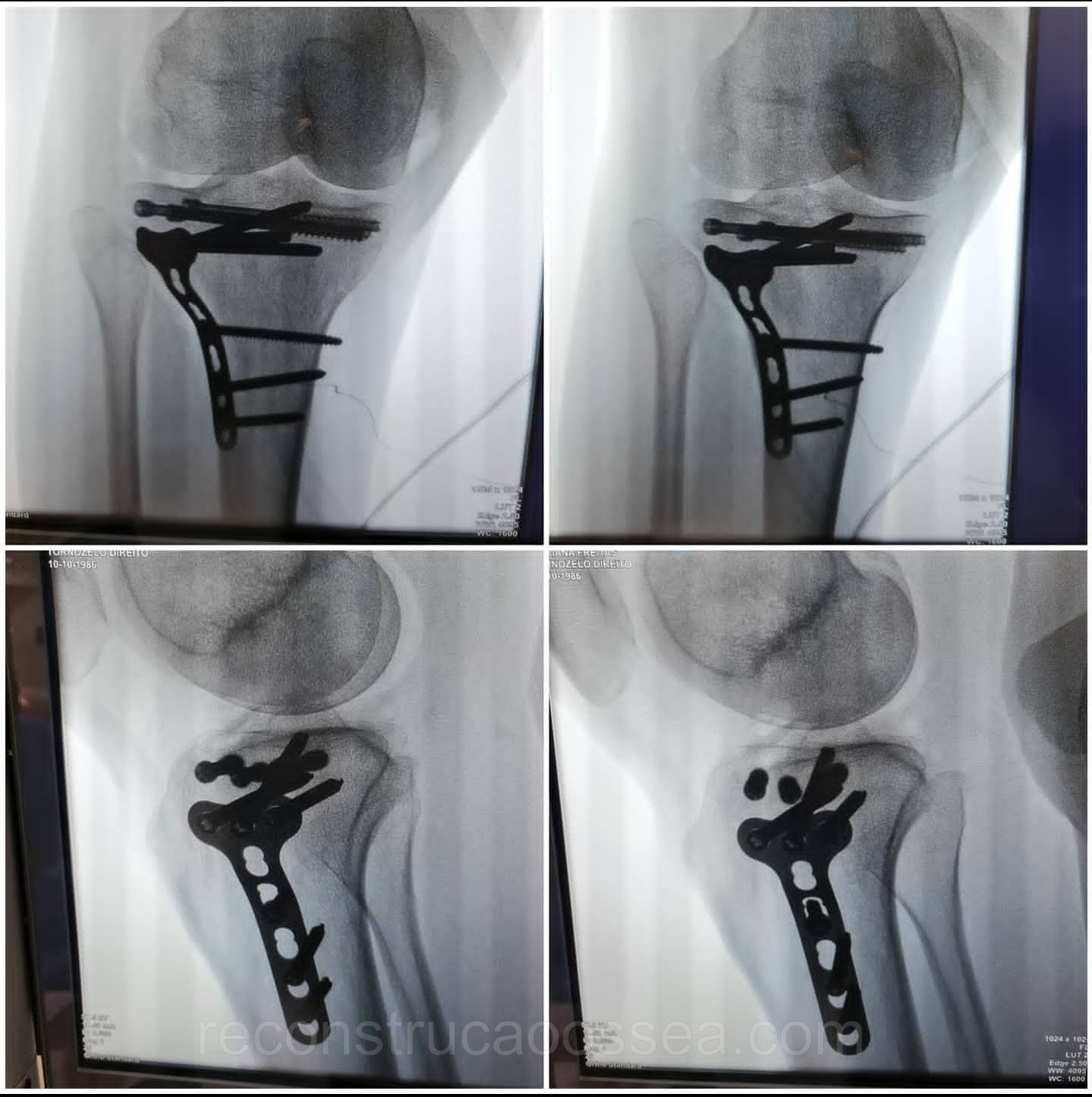 fratura-do-planalto-tibial-tratamento-cirurgico-12