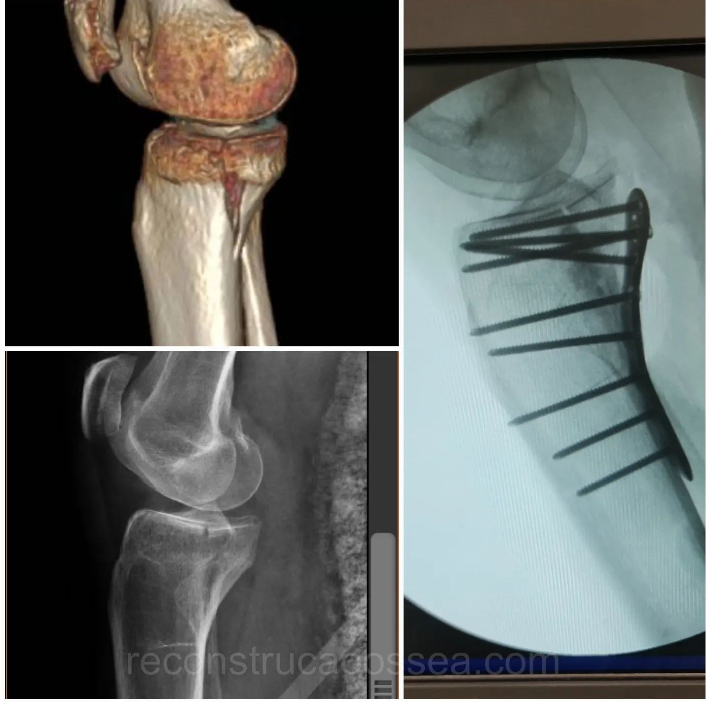 fratura-do-planalto-tibial-tratamento-cirurgico-13