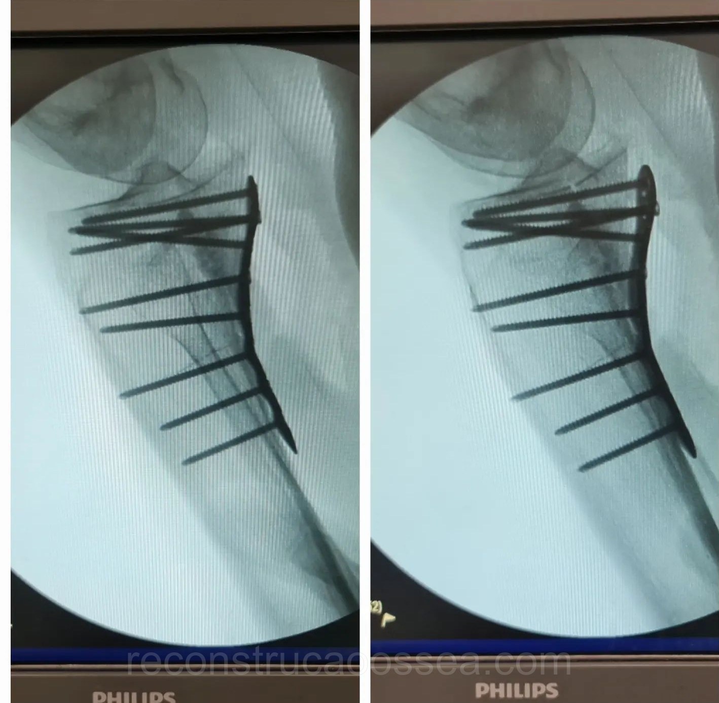 fratura-do-planalto-tibial-tratamento-cirurgico-14