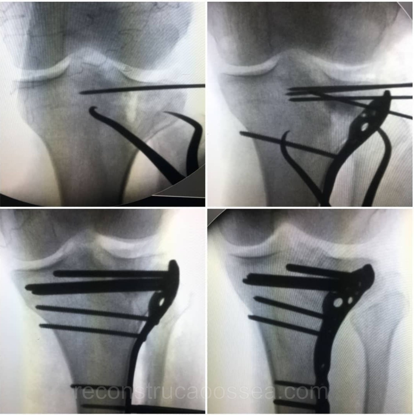 fratura-do-planalto-tibial-tratamento-cirurgico-3