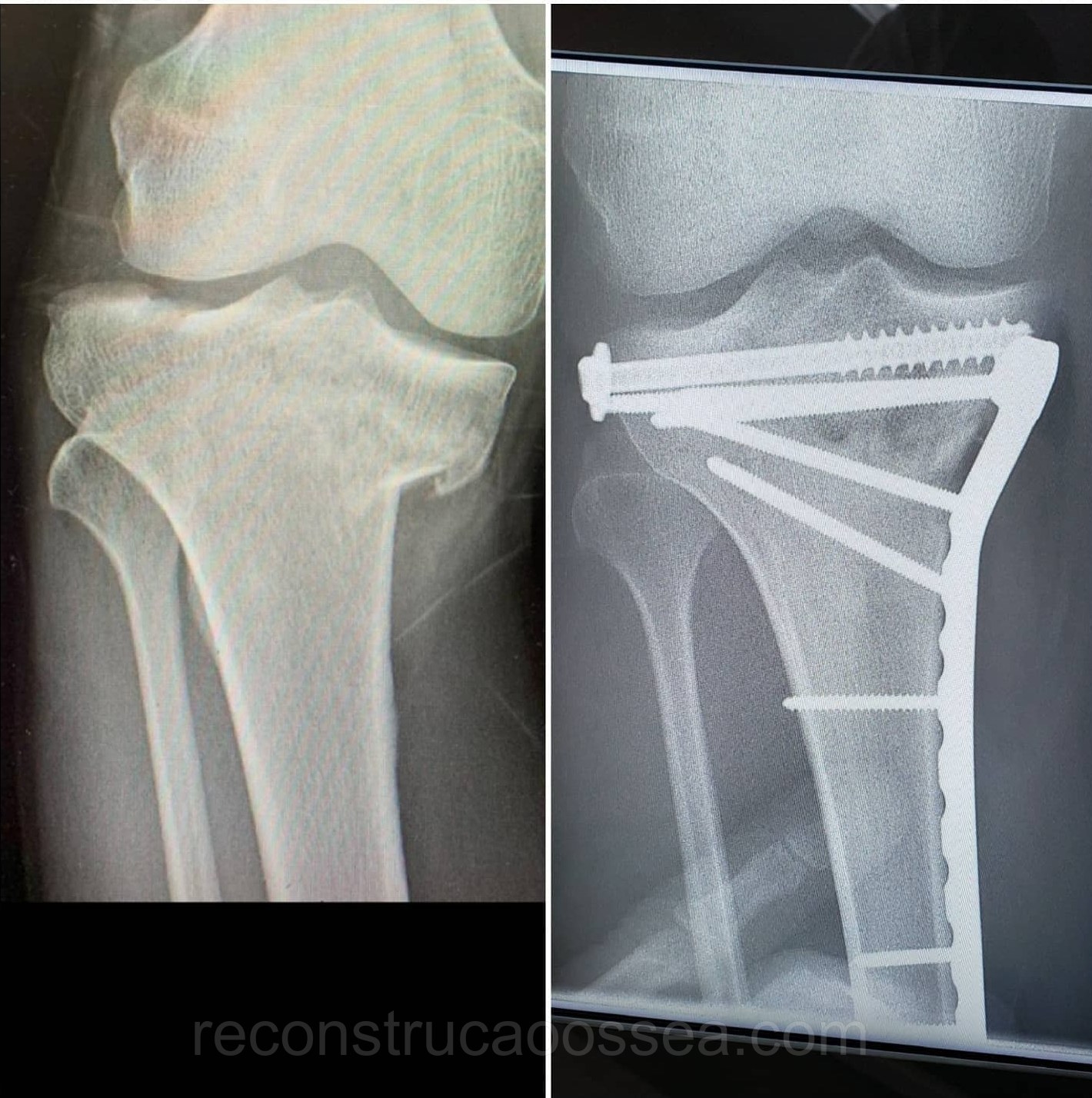 fratura-do-planalto-tibial-tratamento-cirurgico-5