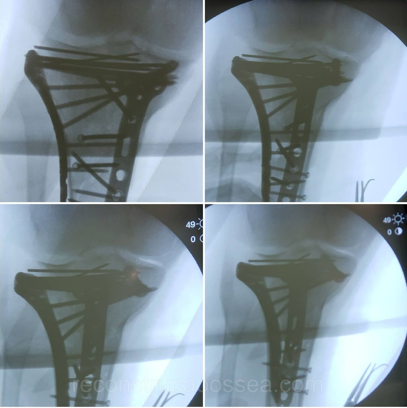 fratura-do-planalto-tibial-tratamento-cirurgico-7