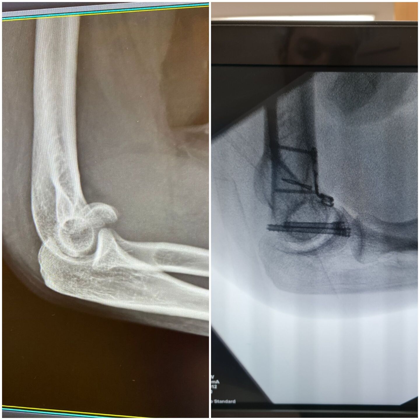 fratura-do-umero-distal-4