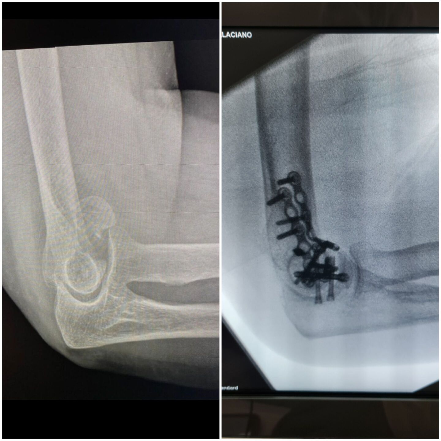 fratura-do-umero-distal-6