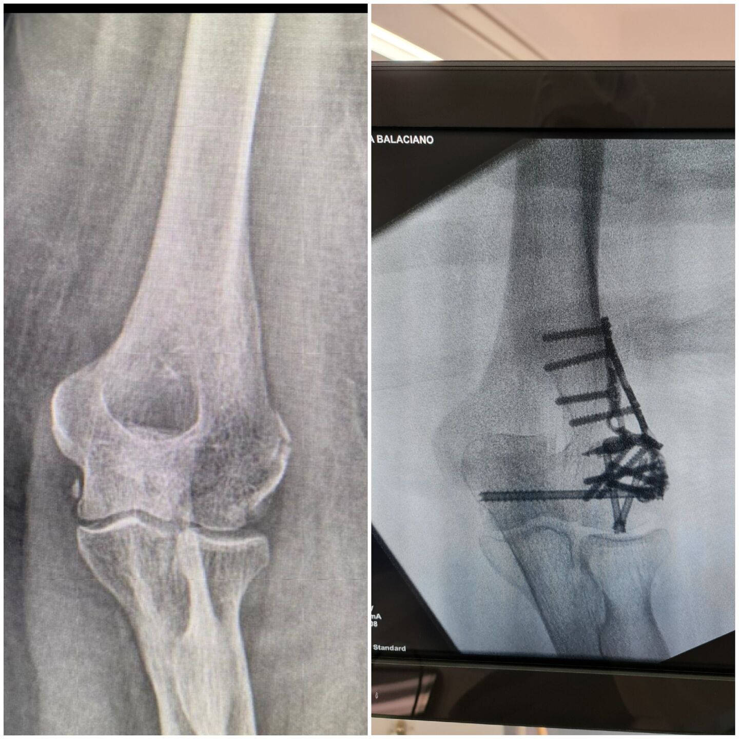 fratura-do-umero-distal-7