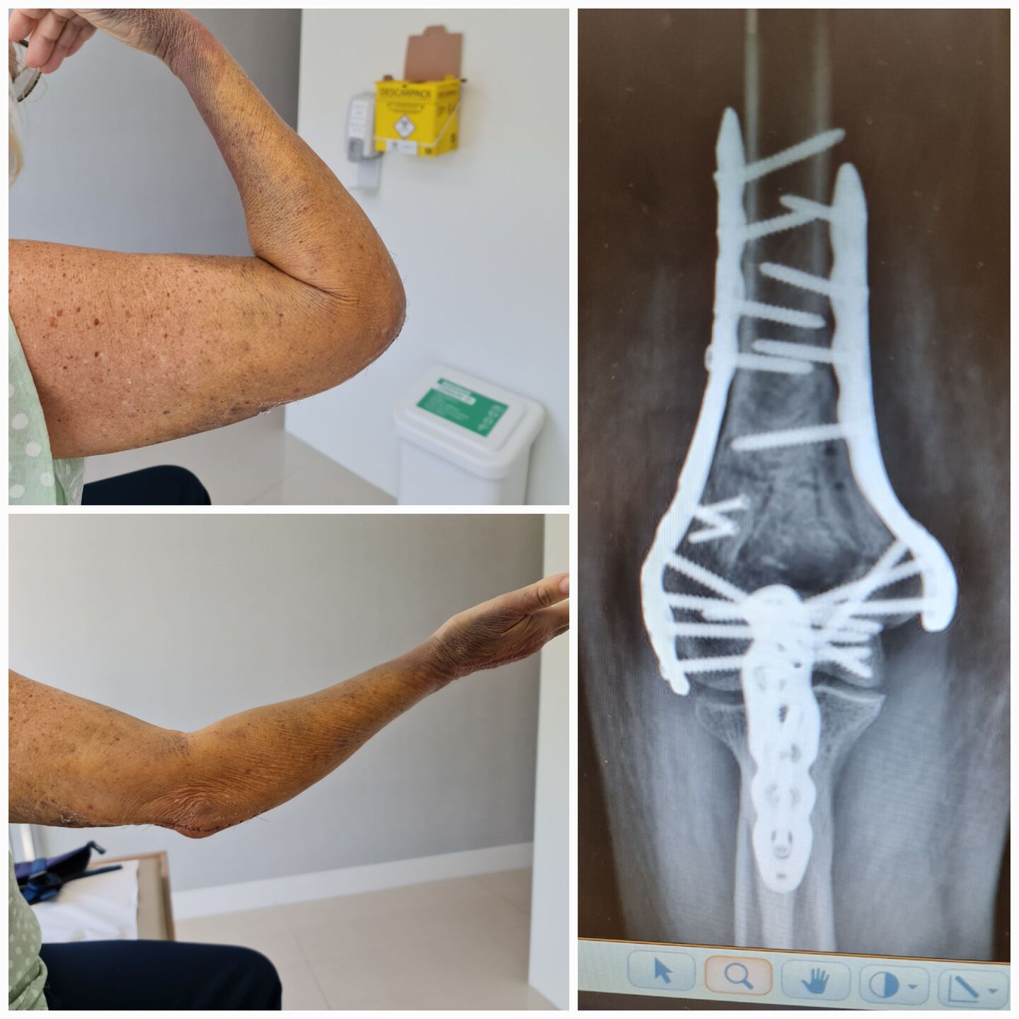 fratura-do-umero-distal-8