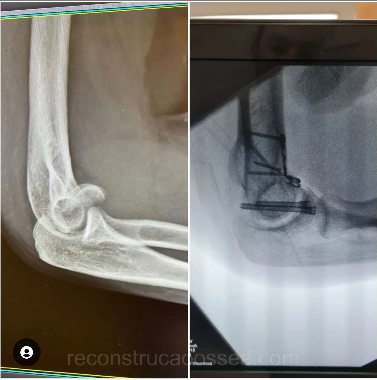 fratura-do-umero-distal-tratamento-cirurgico-12