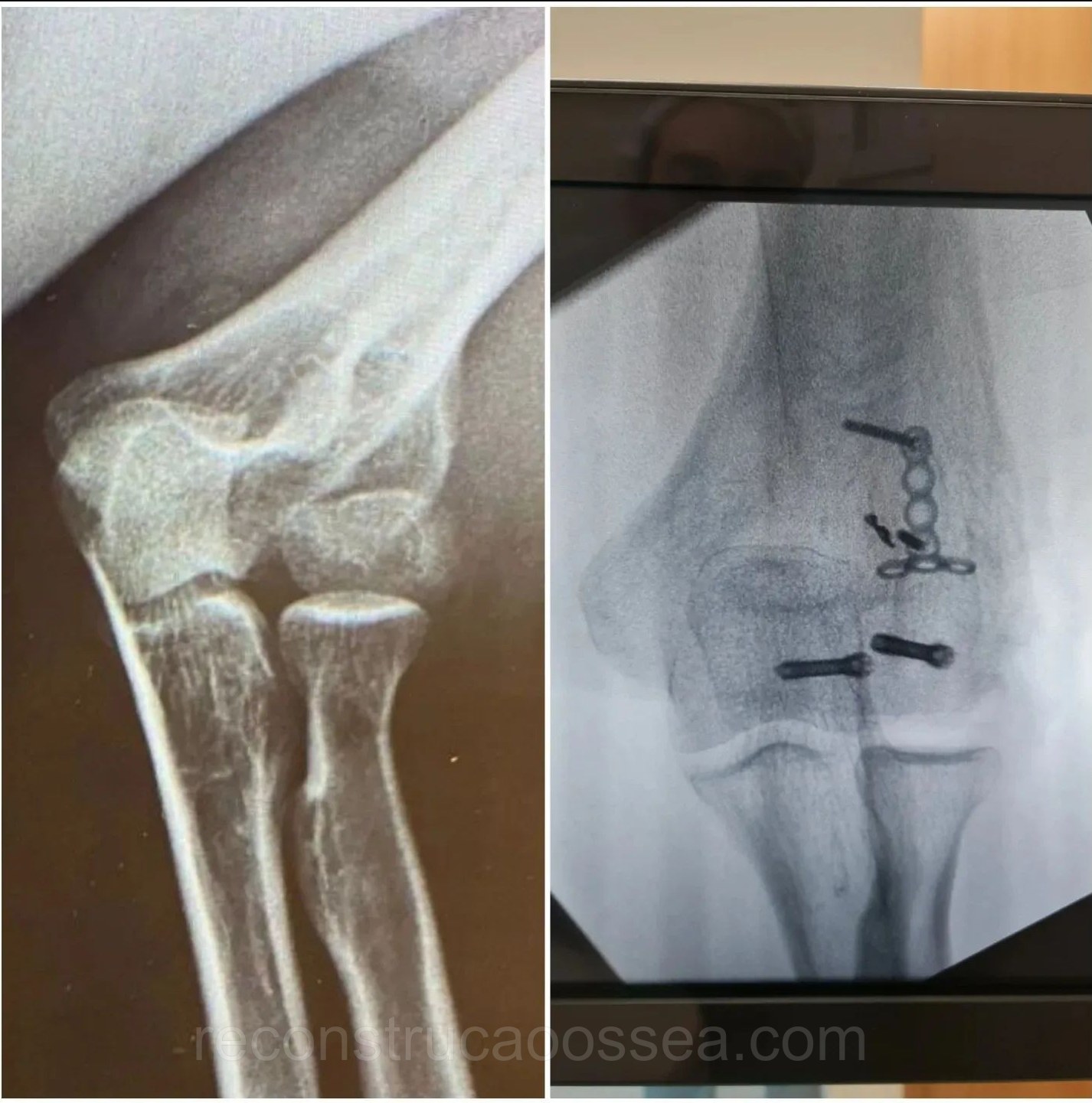 fratura-do-umero-distal-tratamento-cirurgico-13