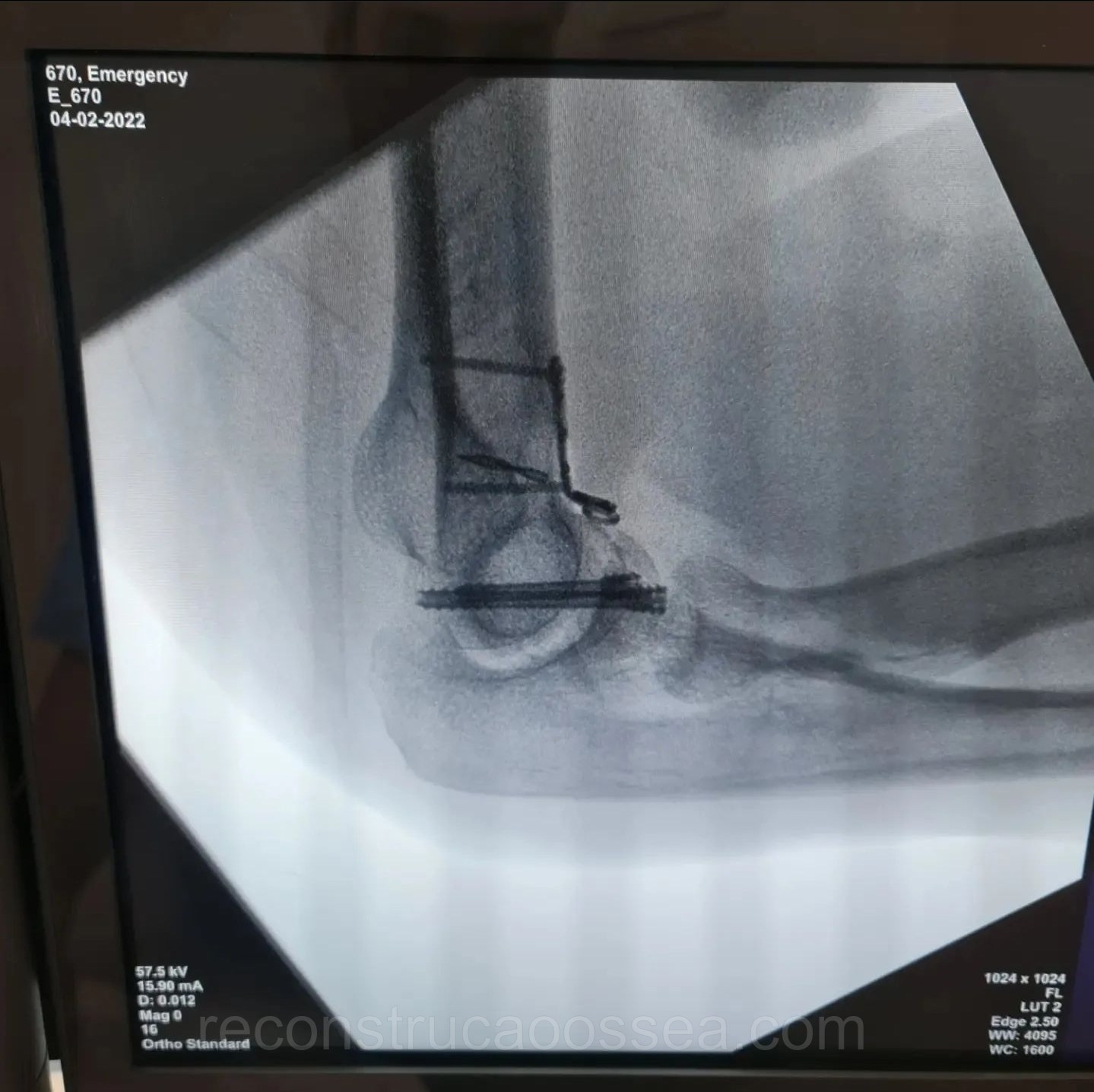fratura-do-umero-distal-tratamento-cirurgico-15