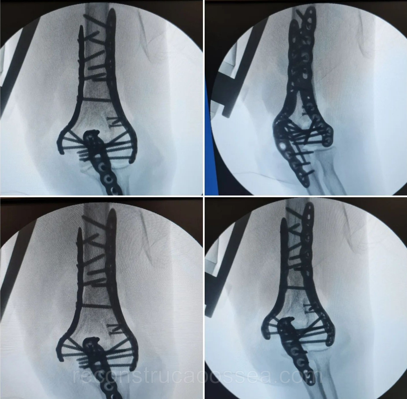 fratura-do-umero-distal-tratamento-cirurgico-17