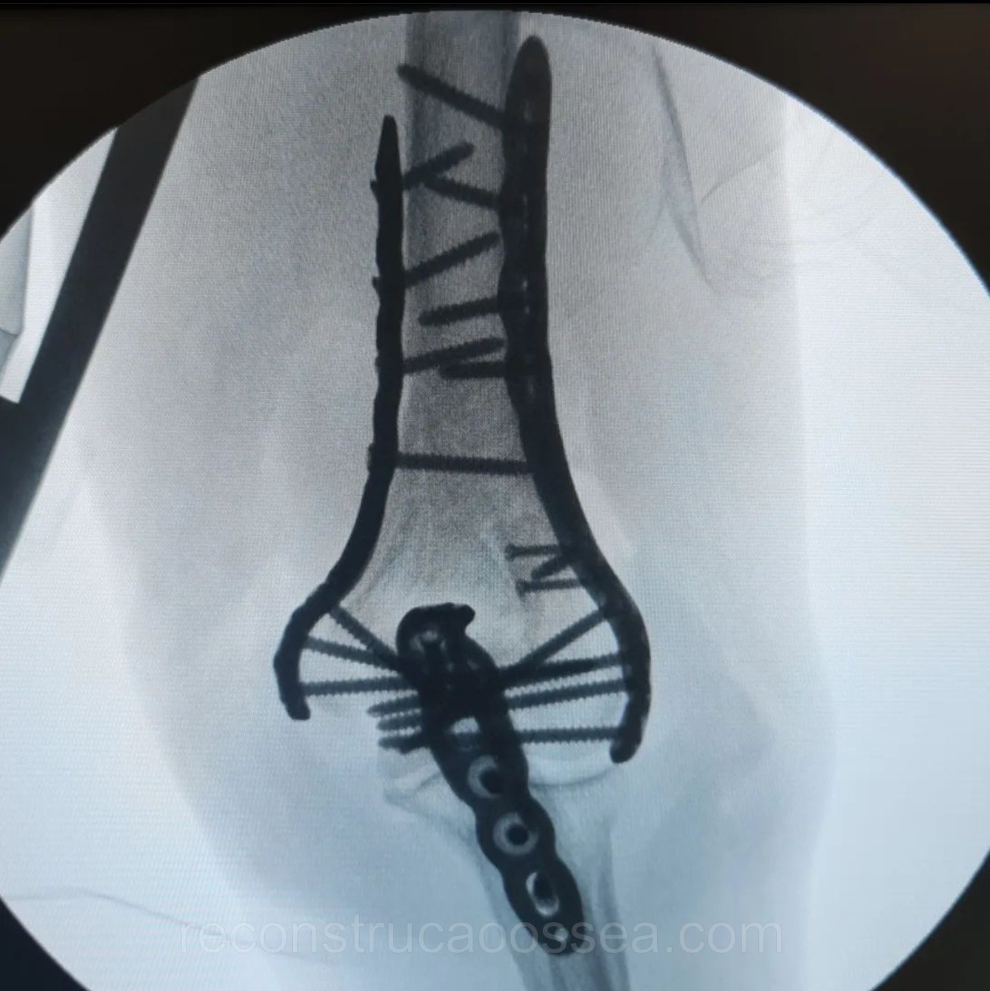 fratura-do-umero-distal-tratamento-cirurgico-18