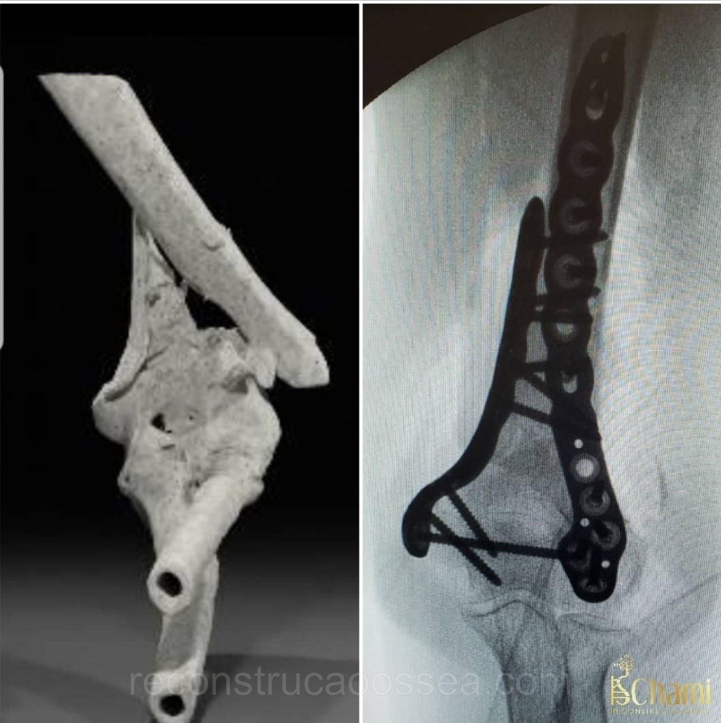 fratura-do-umero-distal-tratamento-cirurgico-4