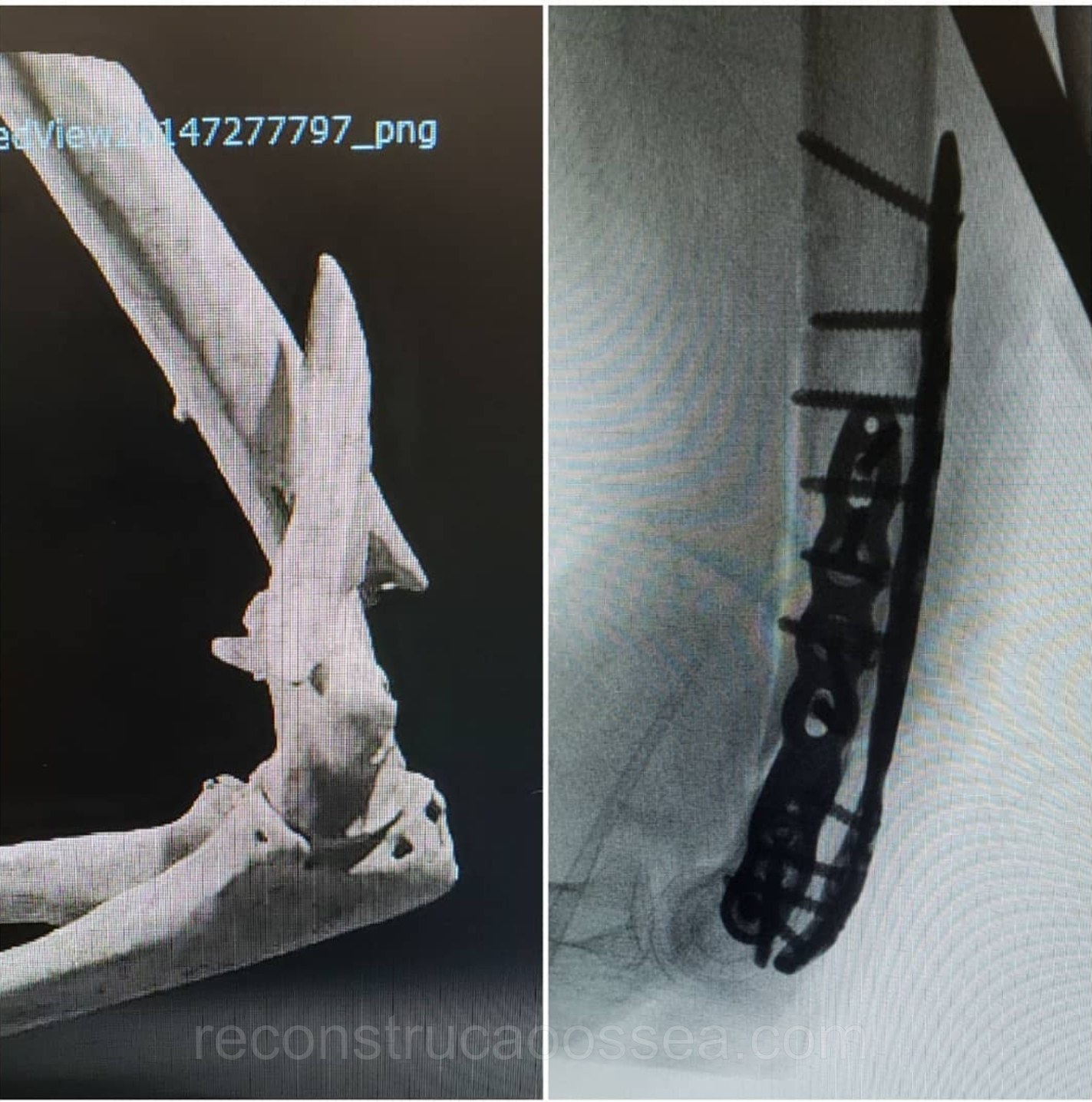 fratura-do-umero-distal-tratamento-cirurgico-5