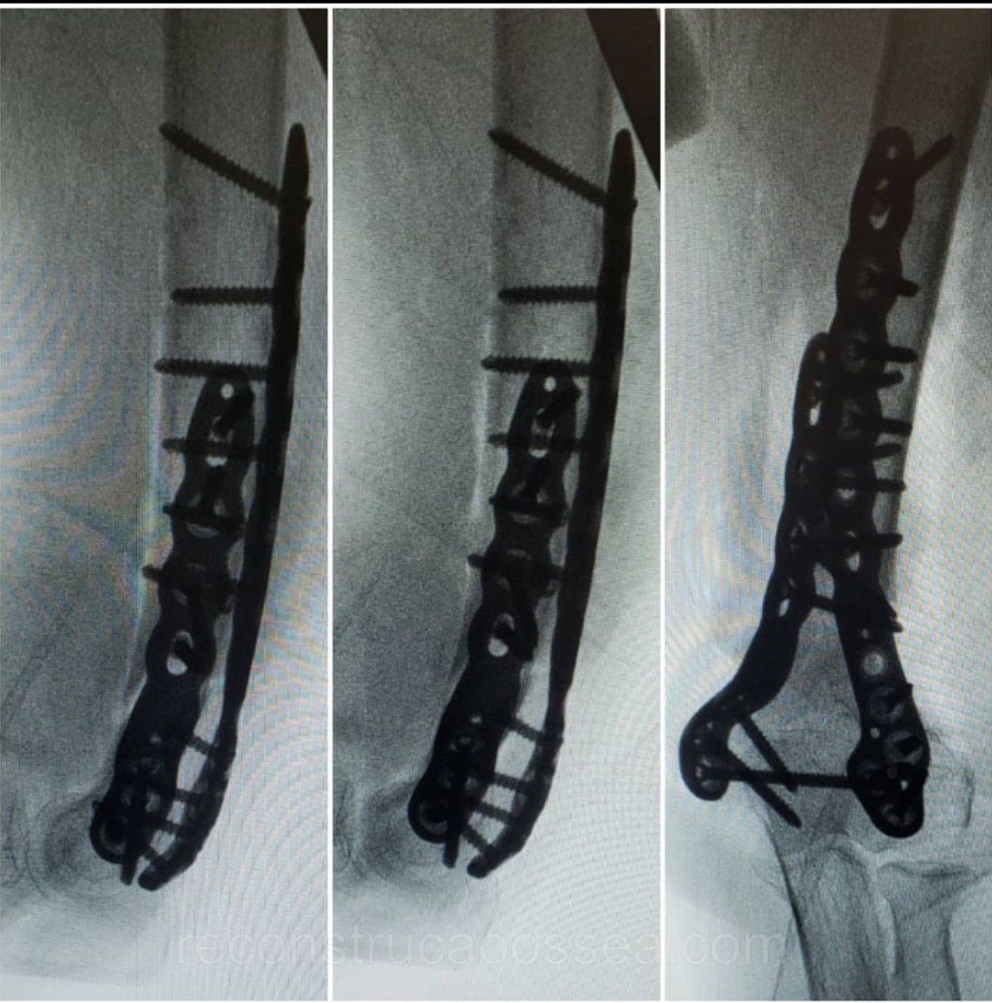 fratura-do-umero-distal-tratamento-cirurgico-7