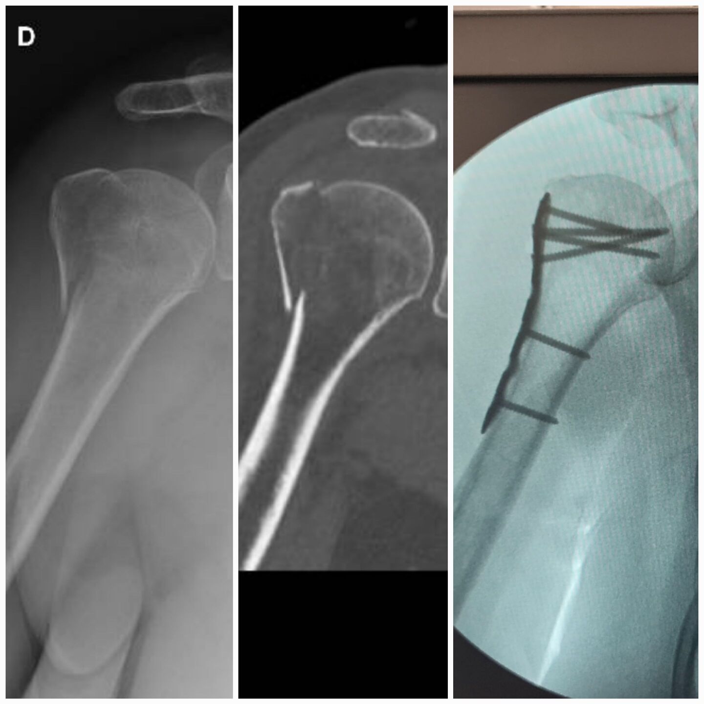 fratura-do-umero-proximal-2