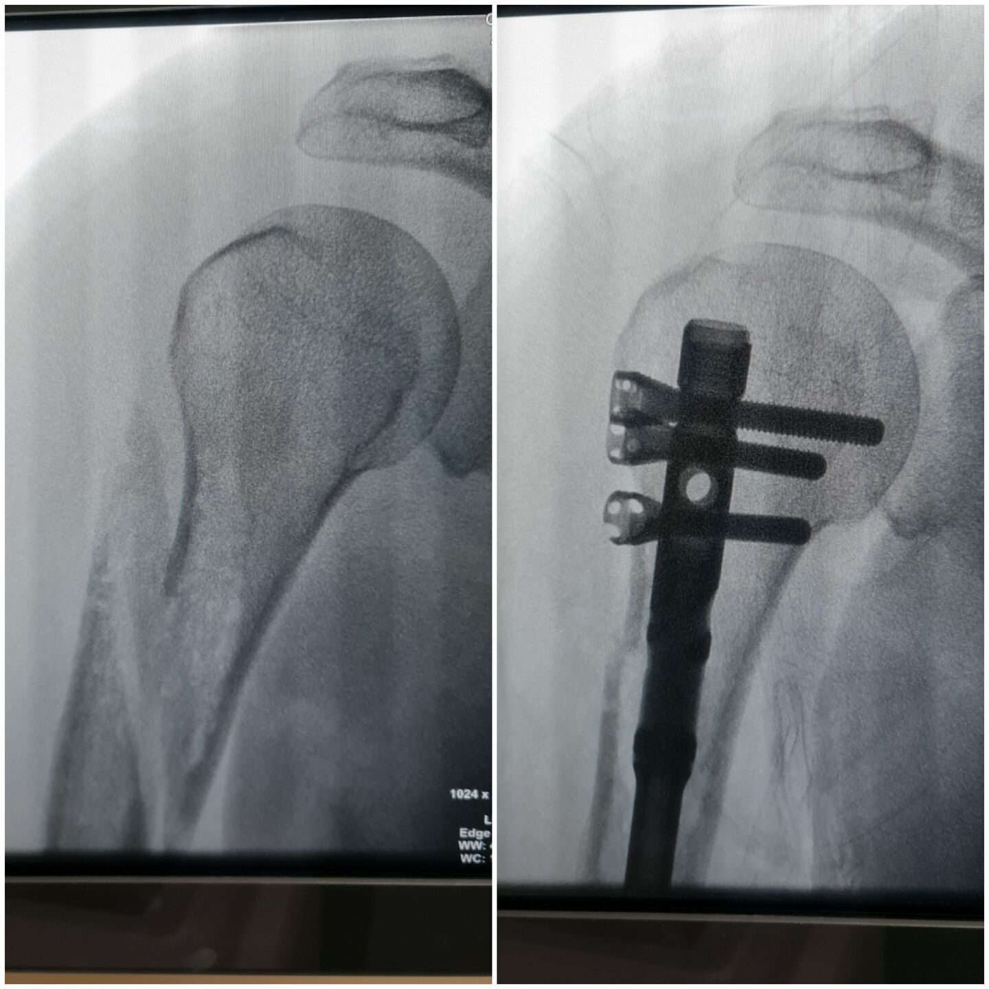 fratura-do-umero-proximal-29