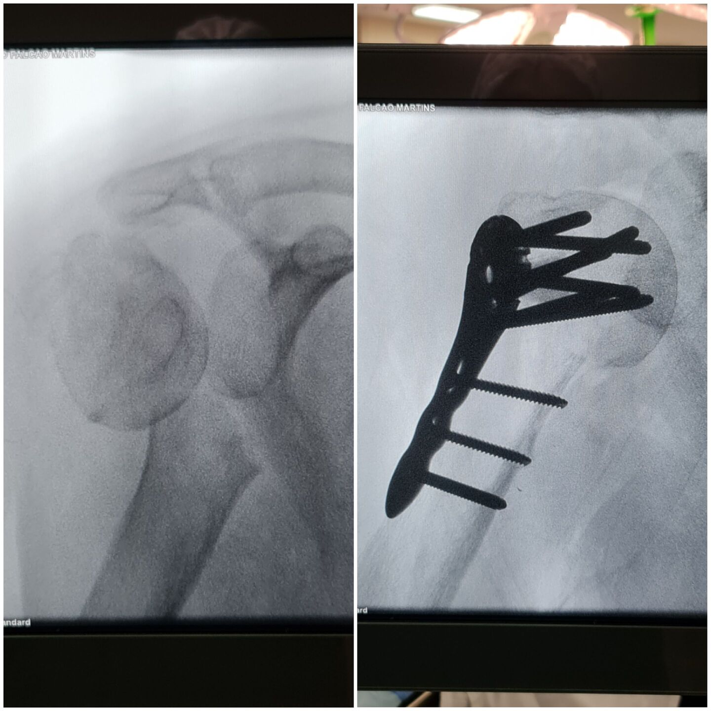 fratura-do-umero-proximal-30