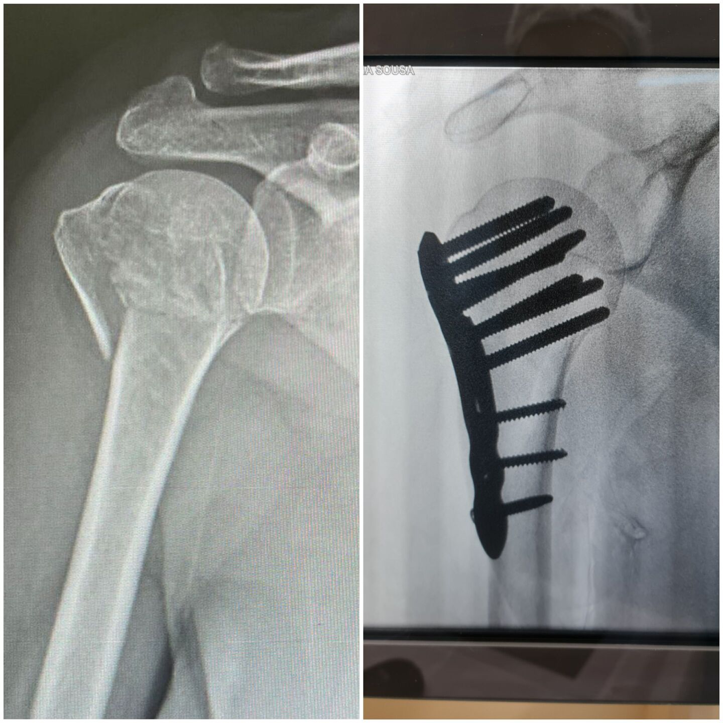 fratura-do-umero-proximal-35