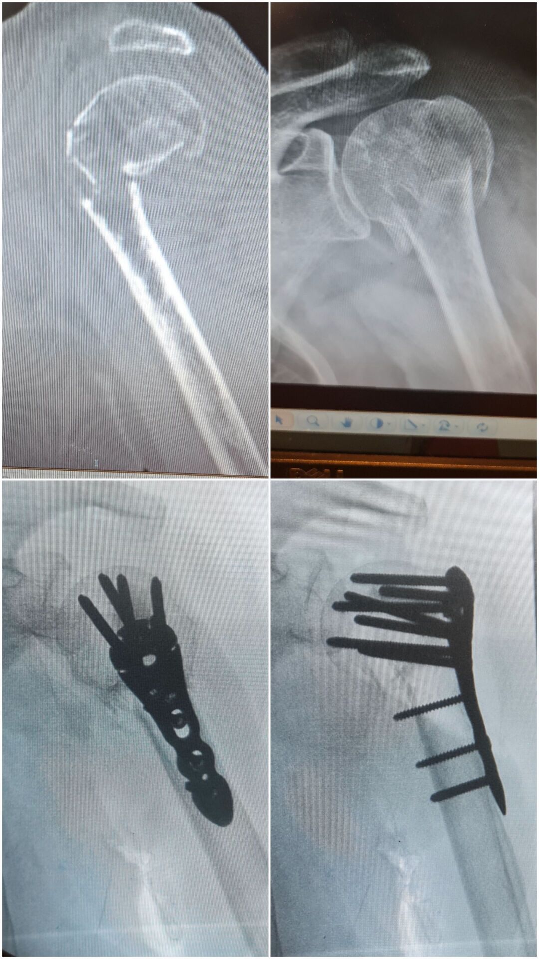 fratura-do-umero-proximal-4