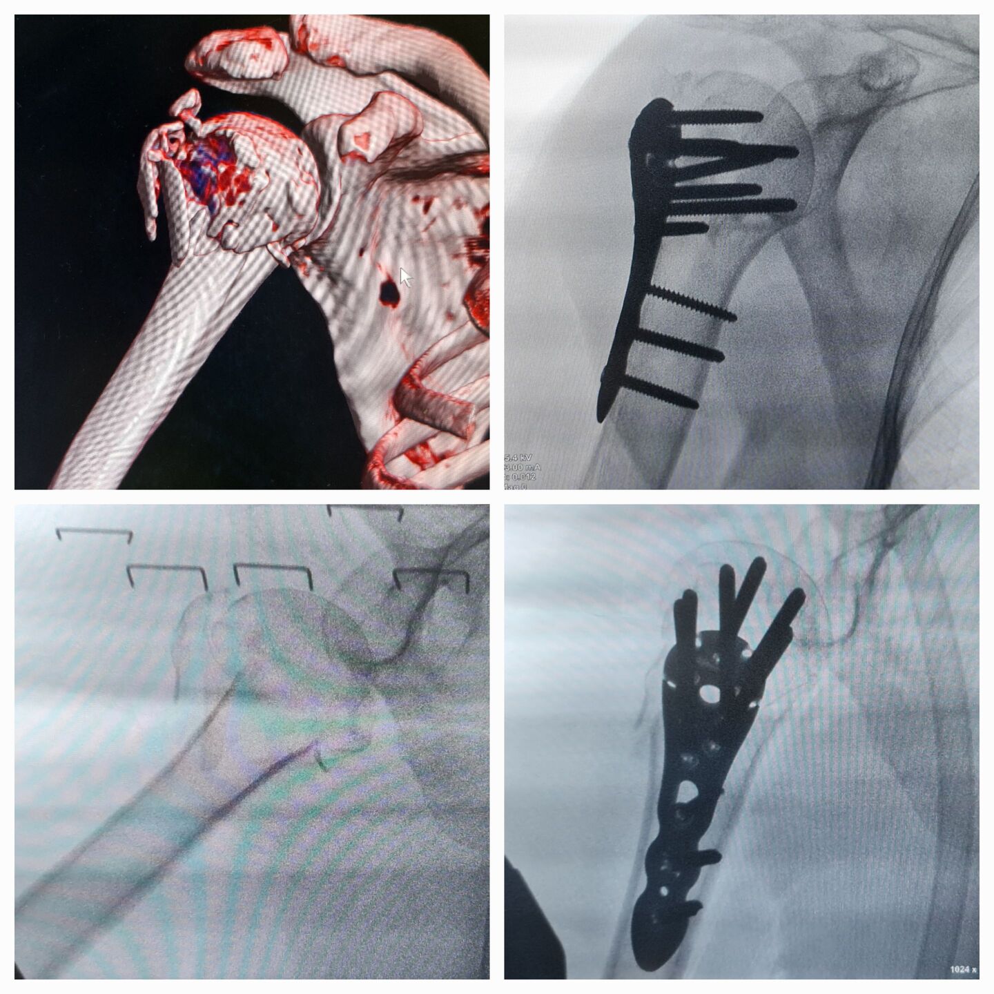 fratura-do-umero-proximal-5