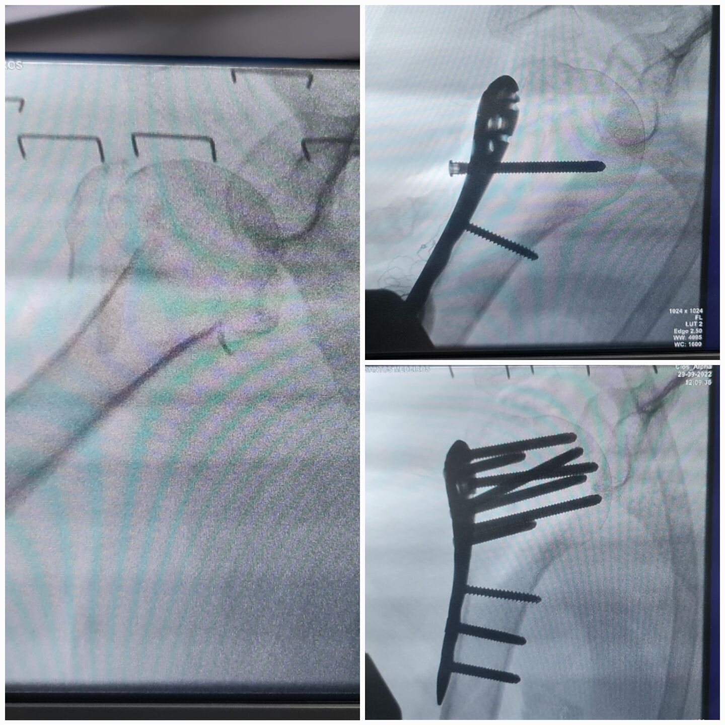 fratura-do-umero-proximal-6