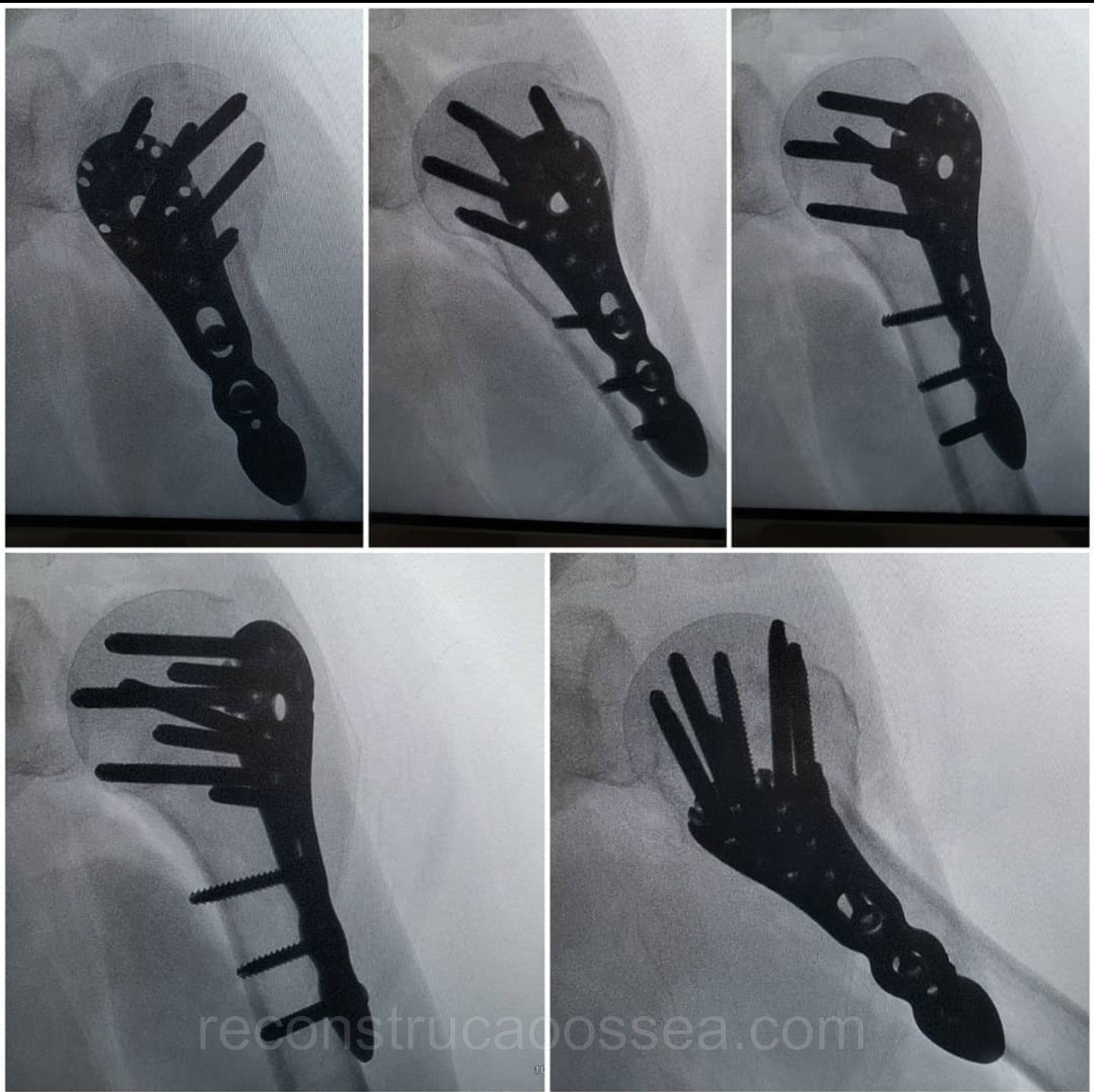 fratura-do-umero-proximal-tratamento-cirurgico-12