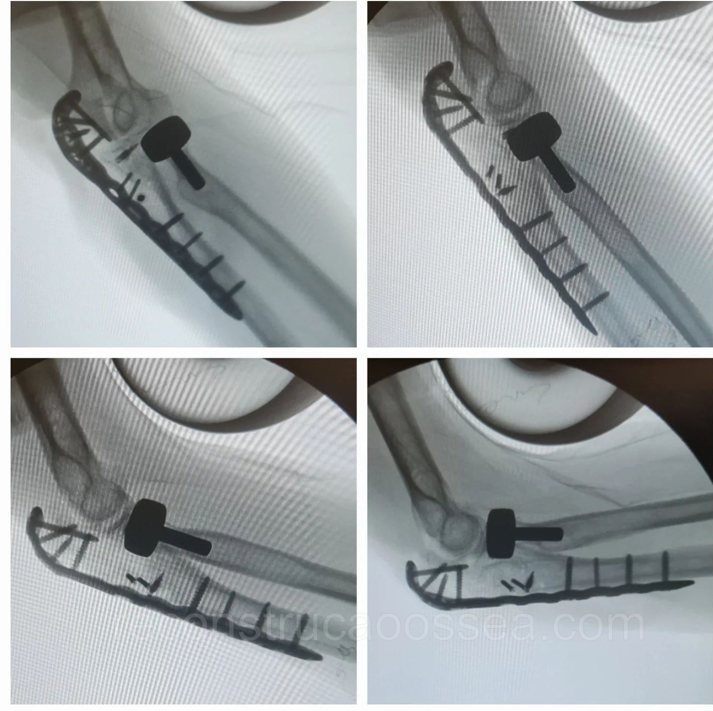 fraturas-complexas-do-cotovelo-triade-terrivel-do-cotovelo-32