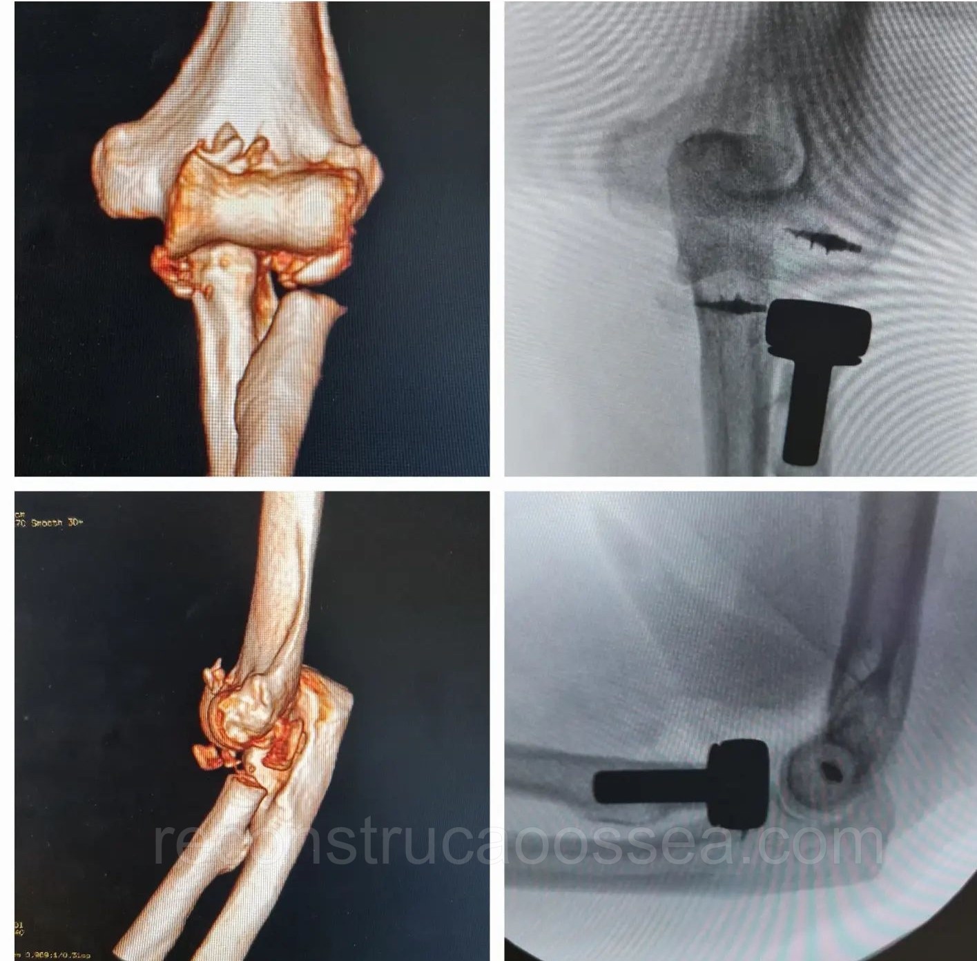 fraturas-complexas-do-cotovelo-triade-terrivel-do-cotovelo-40