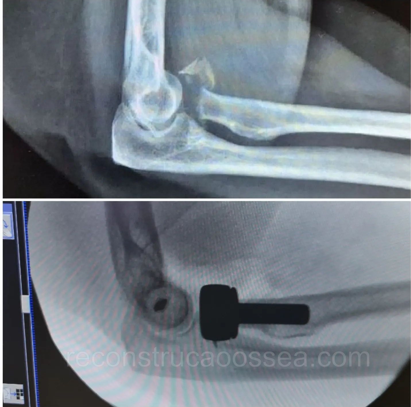 fraturas-complexas-do-cotovelo-triade-terrivel-do-cotovelo-42
