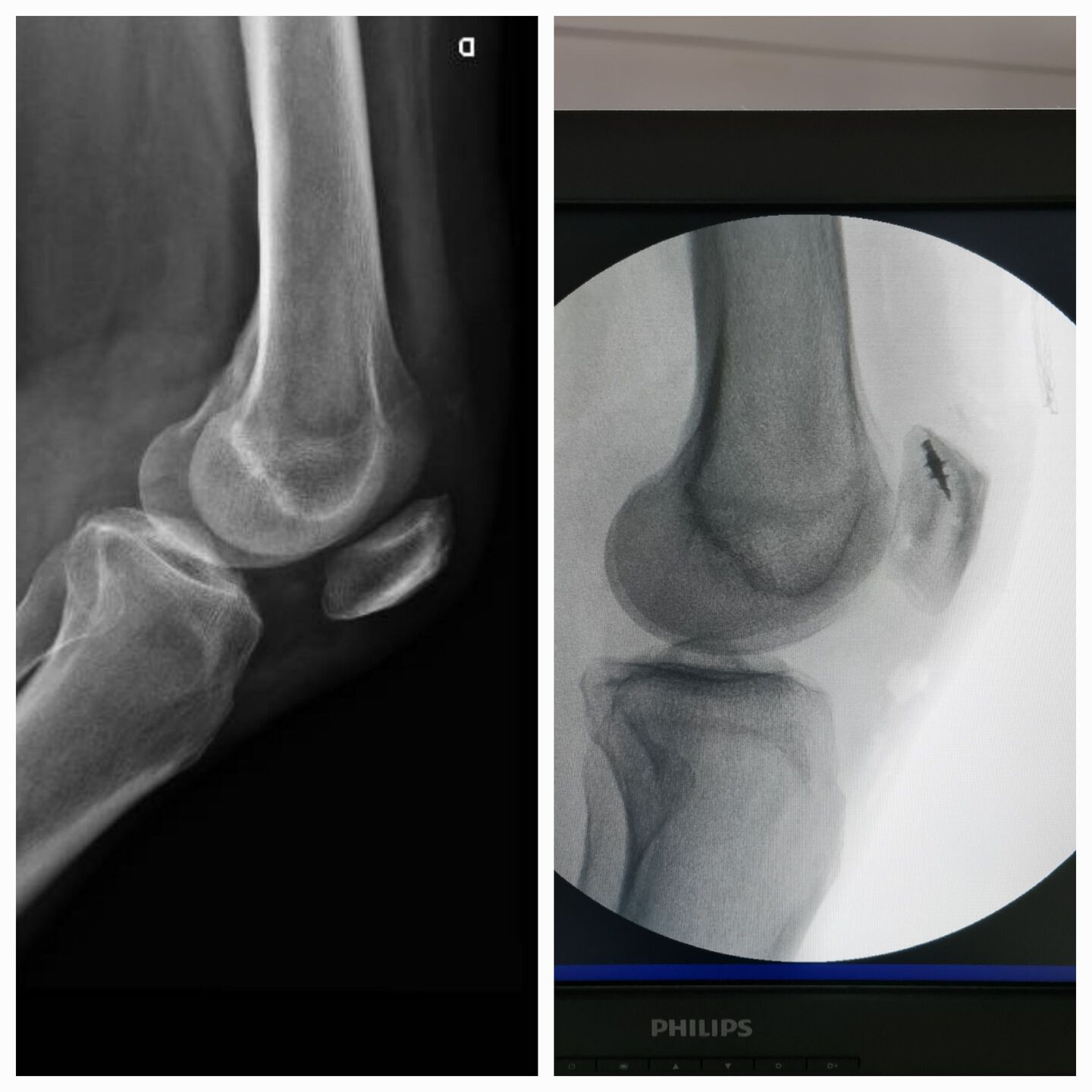 lesao-do-tendao-do-quadriceps