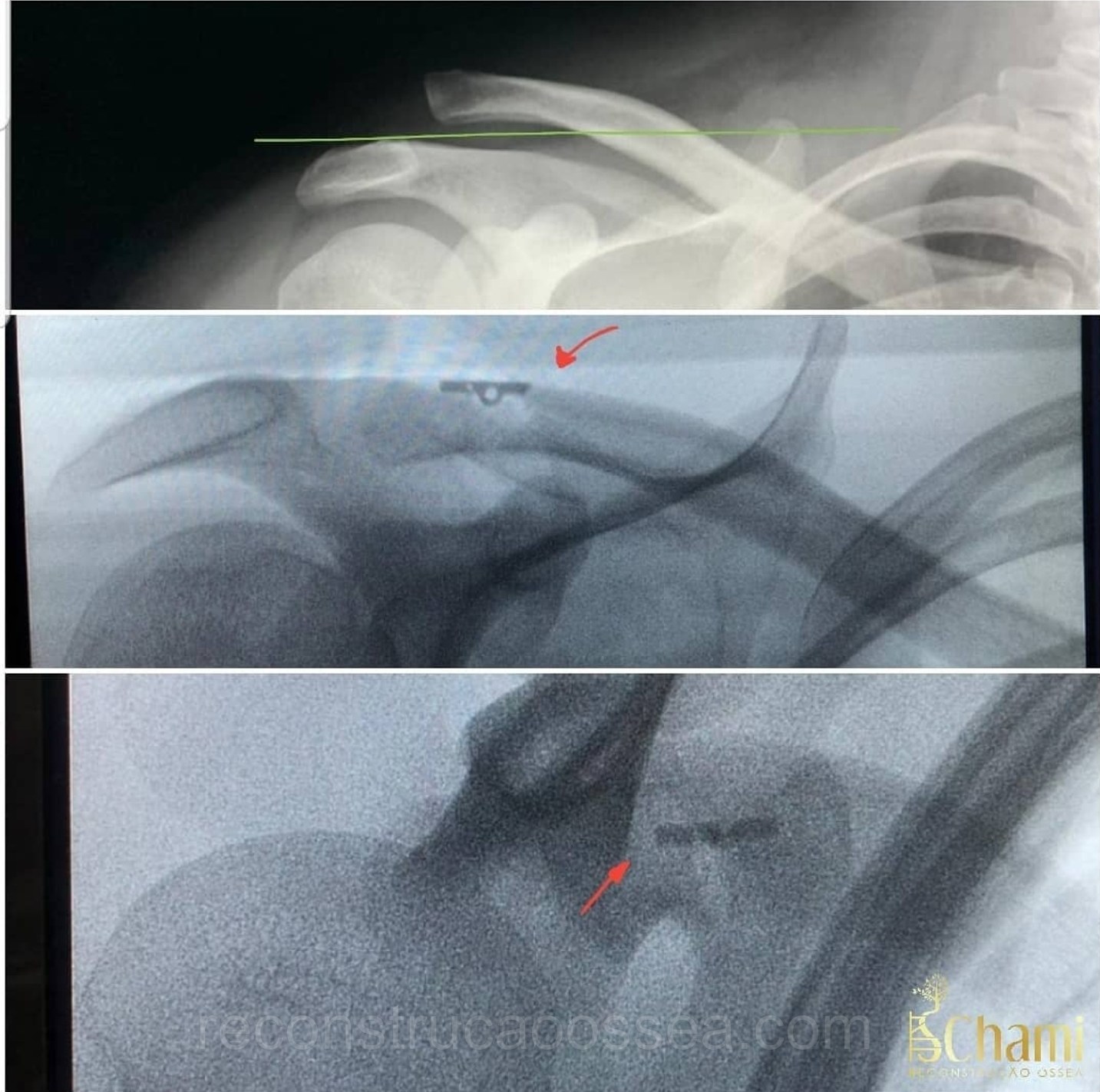 luxacao-acromio-clavicular-tratamento-cirurgico-1