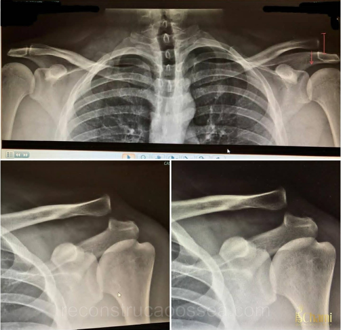 luxacao-acromio-clavicular-tratamento-cirurgico-3